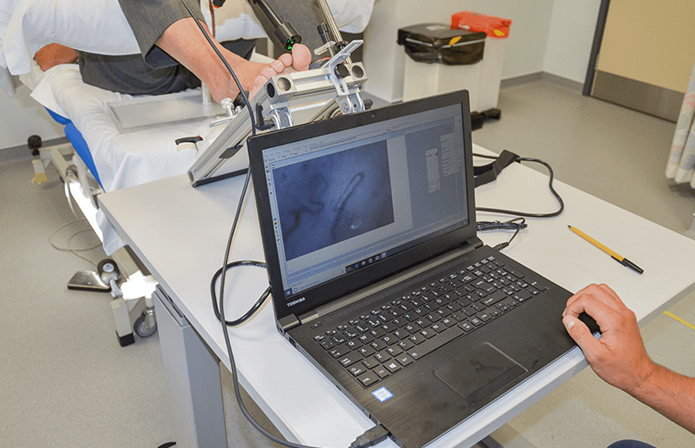 Foot nail fold capillary measurements